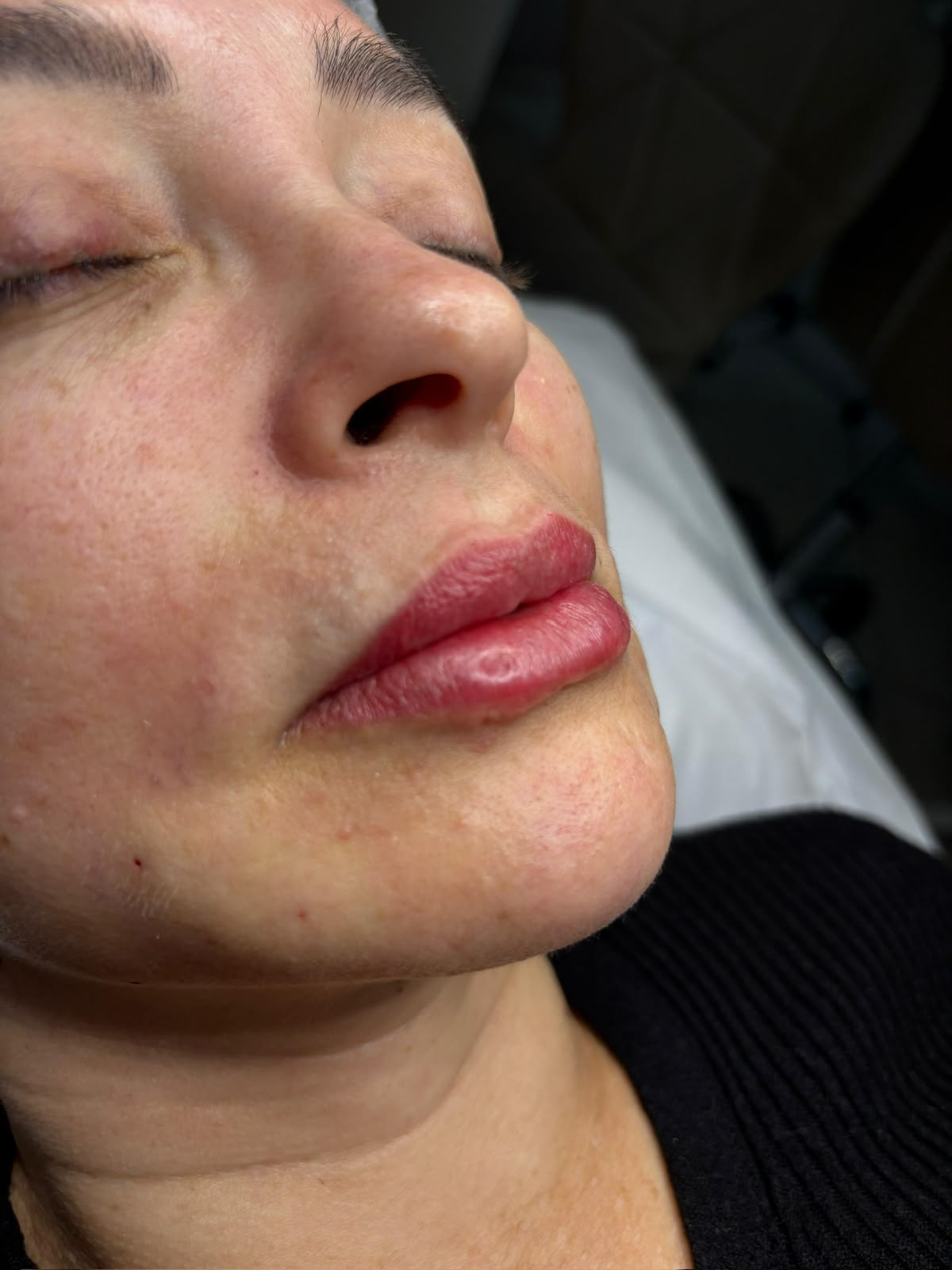 Preenchimento com Ácido Hialurônico em Porto Velho - RO — Fabiana Rocha Centro de Estética
